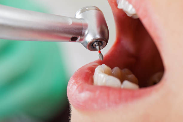 Best Emergency Dental Care for Broken or Chipped Teeth in Red Hill, SC